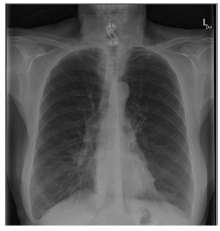 chest x ray