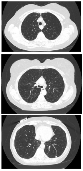 CT scans