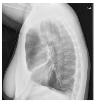 chest xray