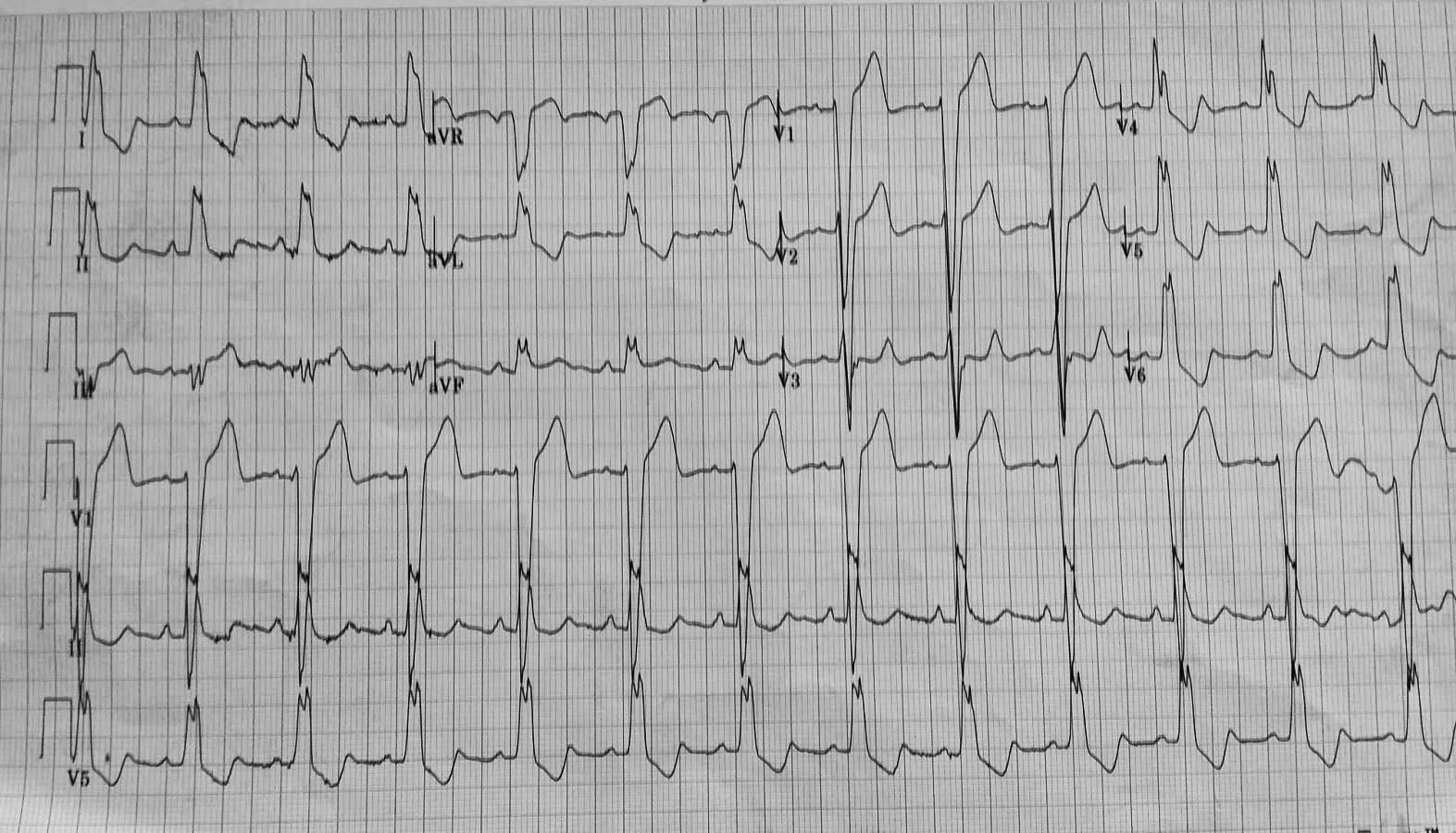 left bundle branch block