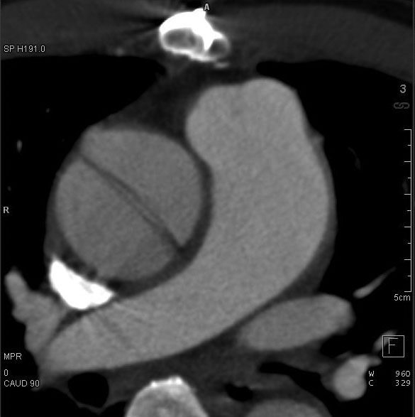 type A dissection