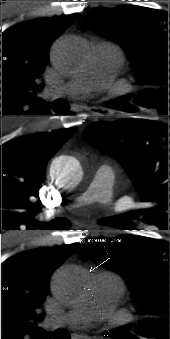 CT intramural hematoma