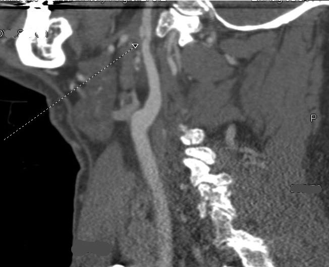 internal carotid with intimal flap