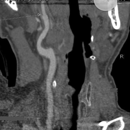 internal carotid artery with intimal flap