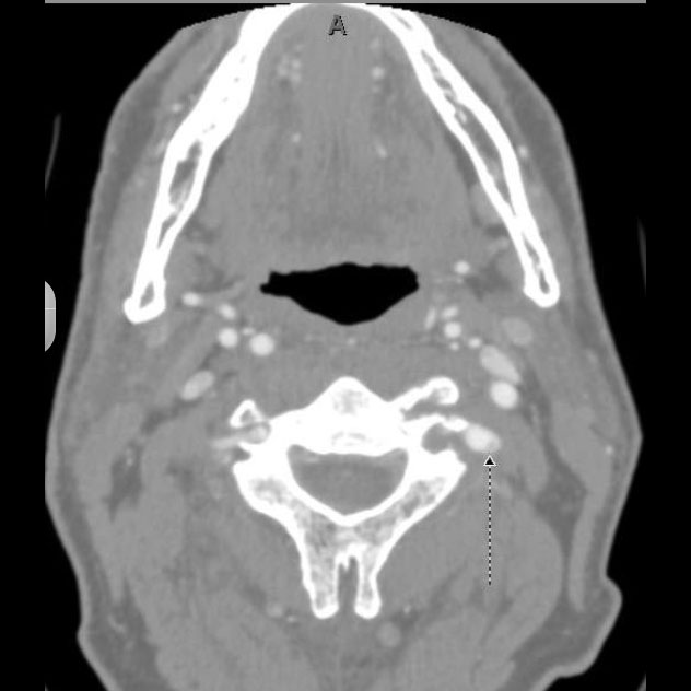 vertebral dissection with pseudoaneurysm