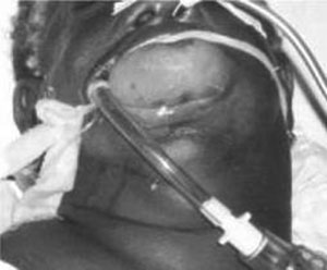 oral angioedema