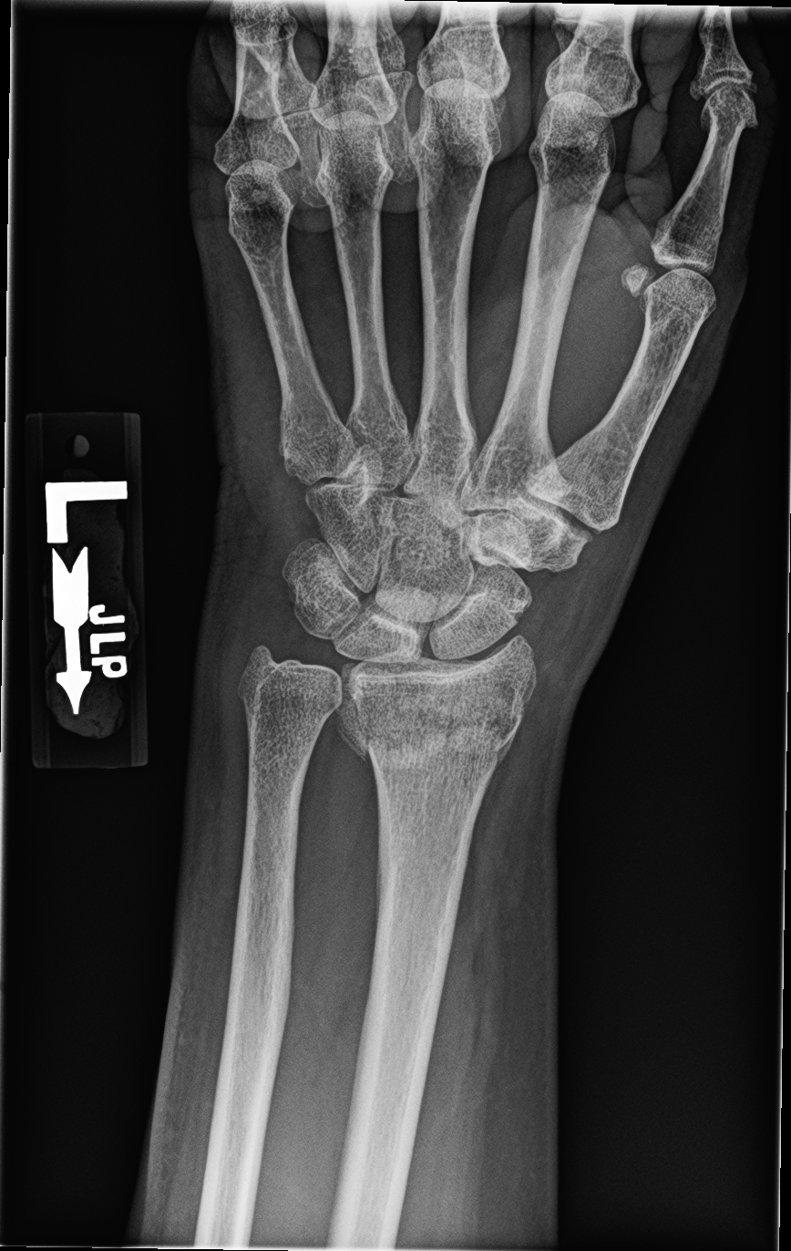 distal radius fracture