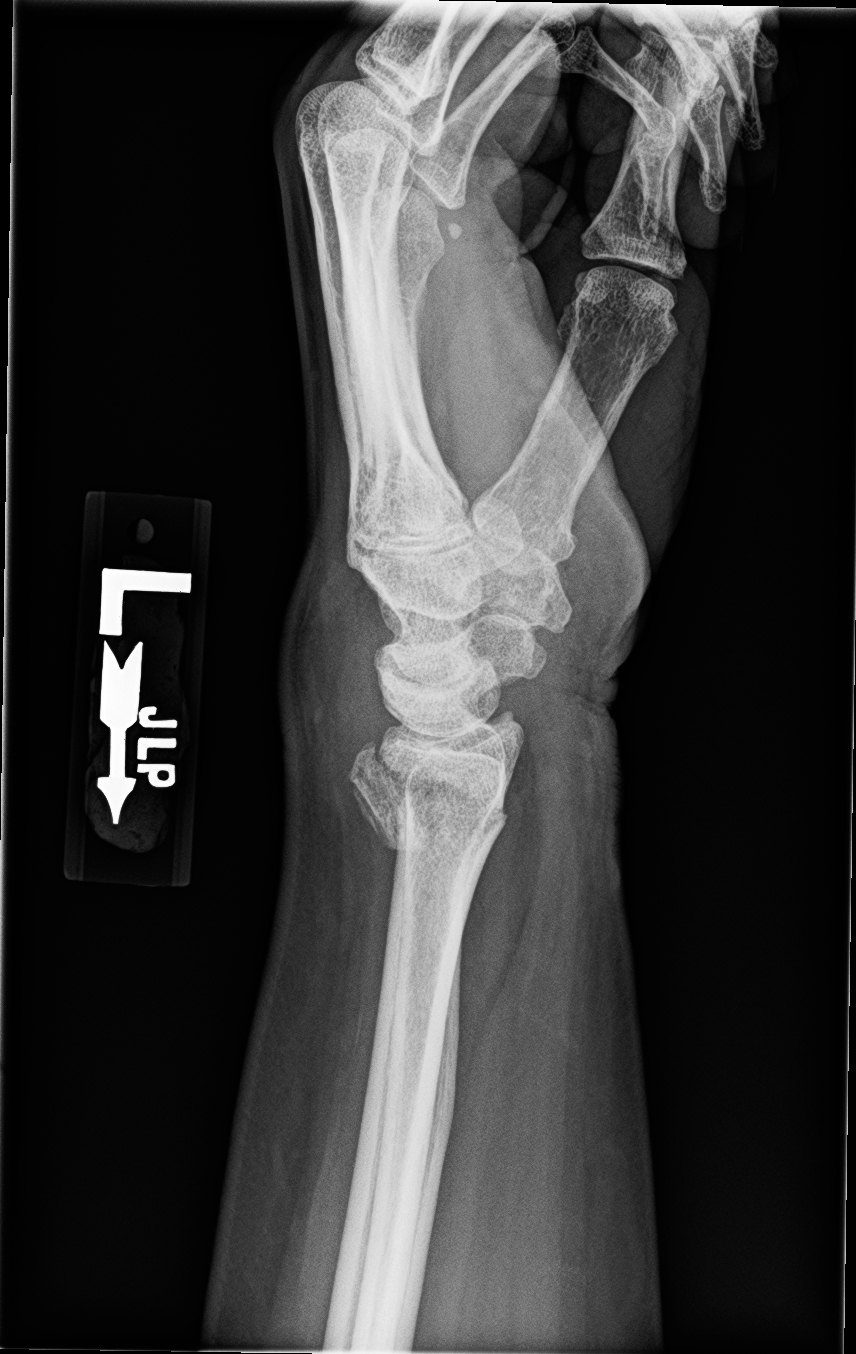 distal radius fracture