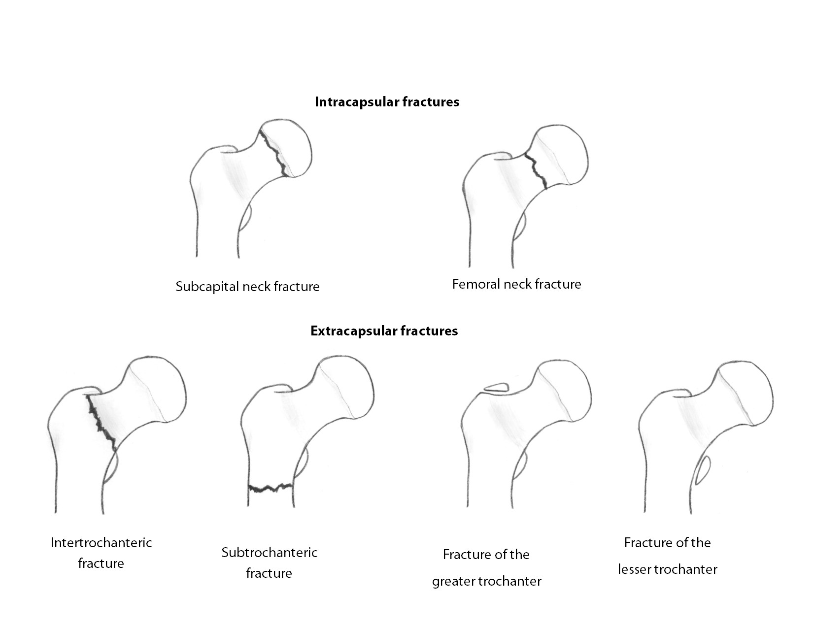 hip fracture classification