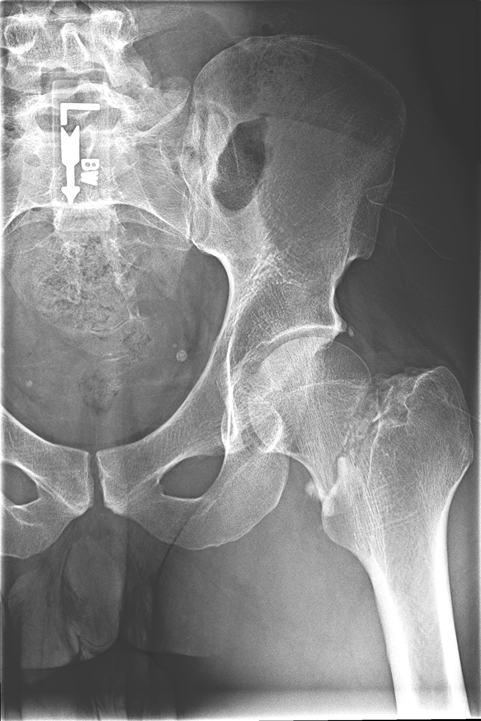 femoral neck fracture