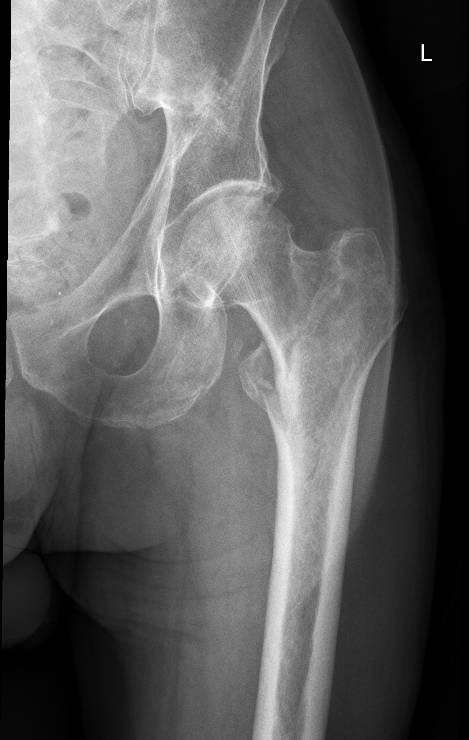 hip fracture