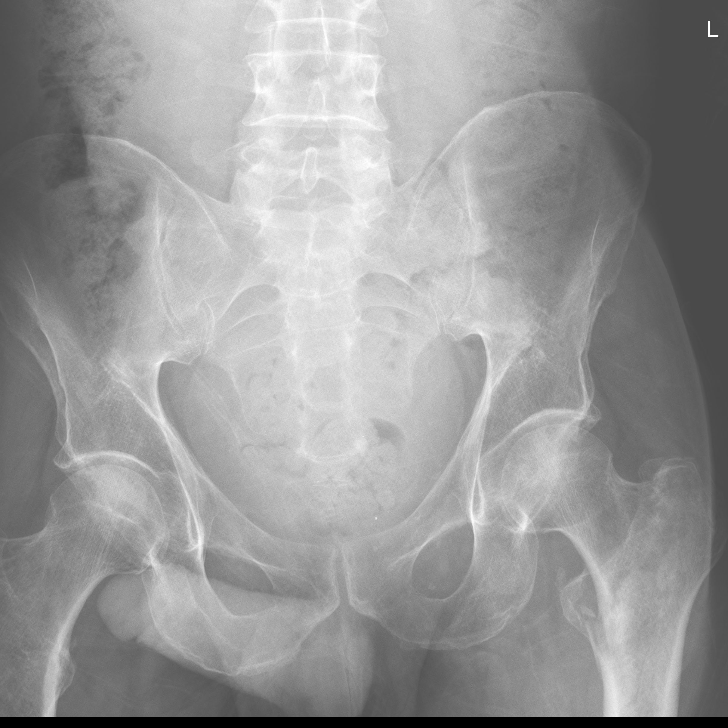 hip fracture
