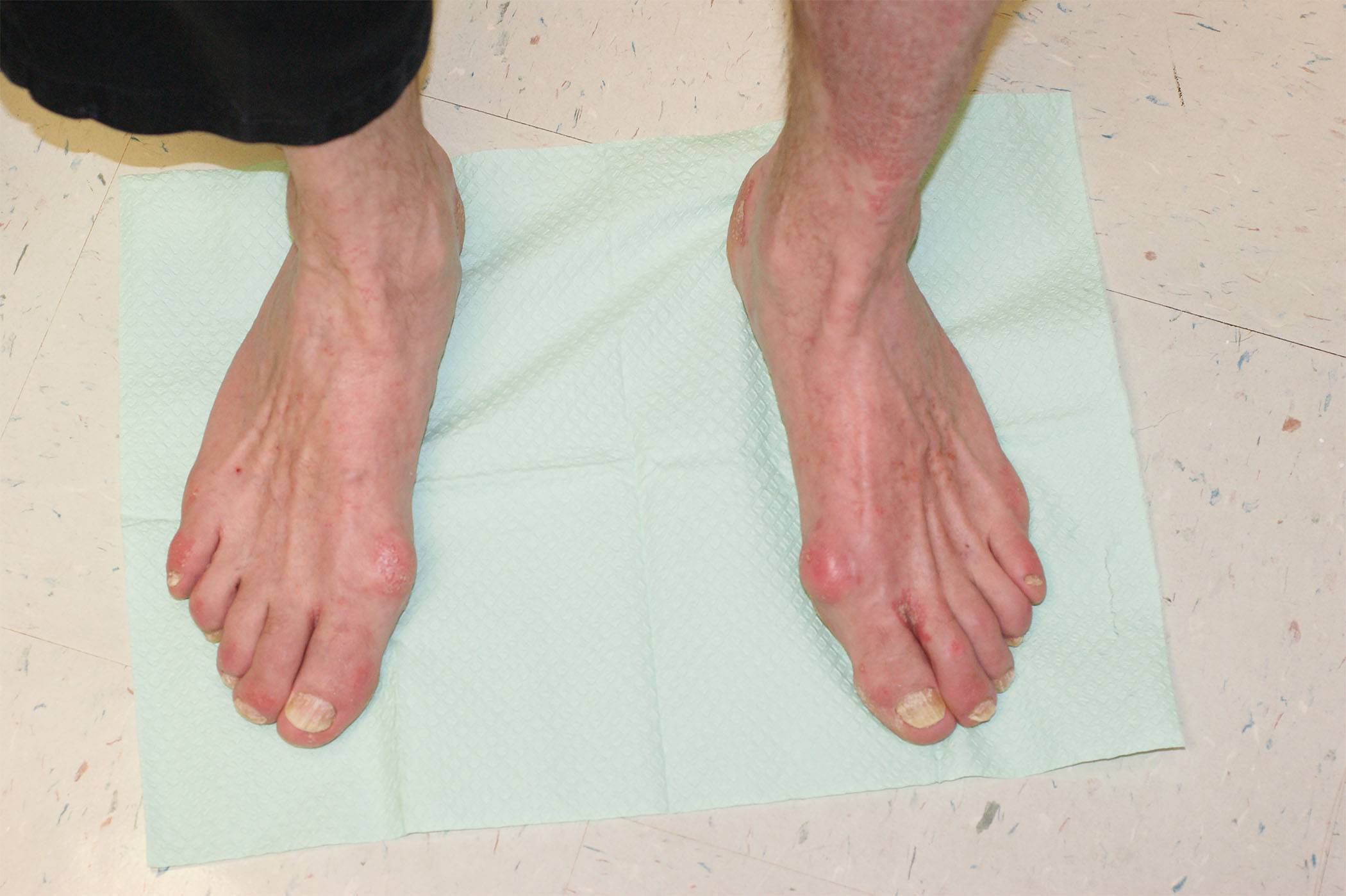Intrinsic minus foot