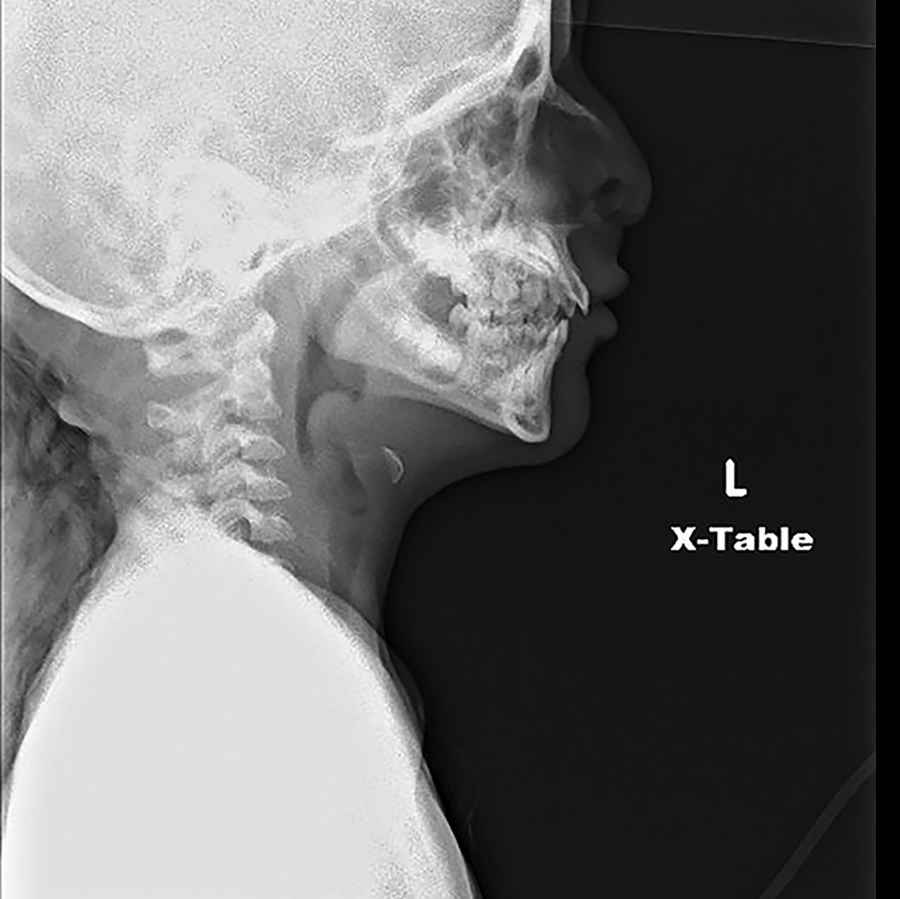 epiglottitis