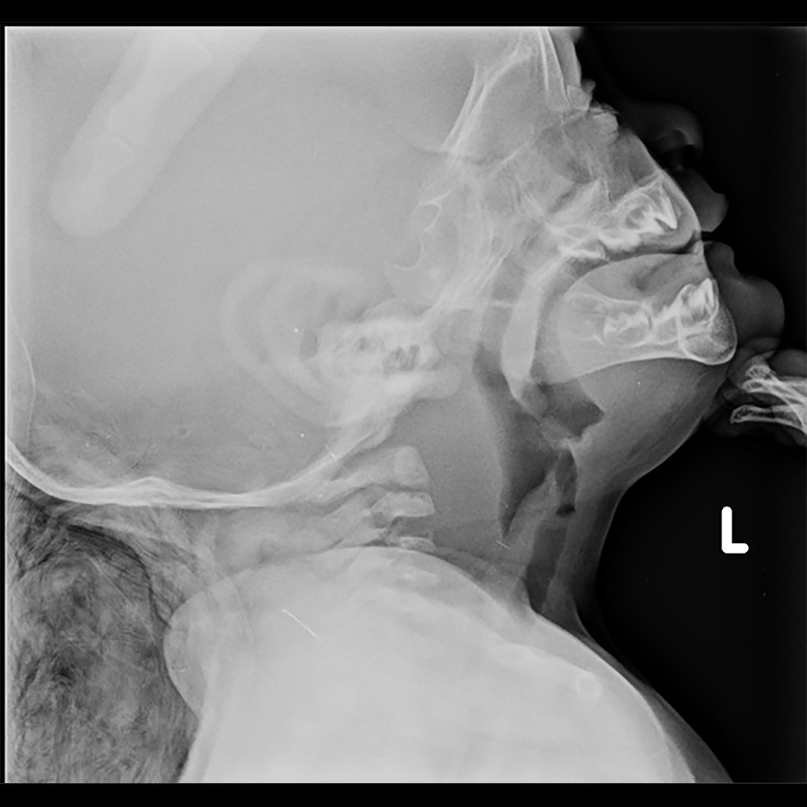 retropharyngeal abscess