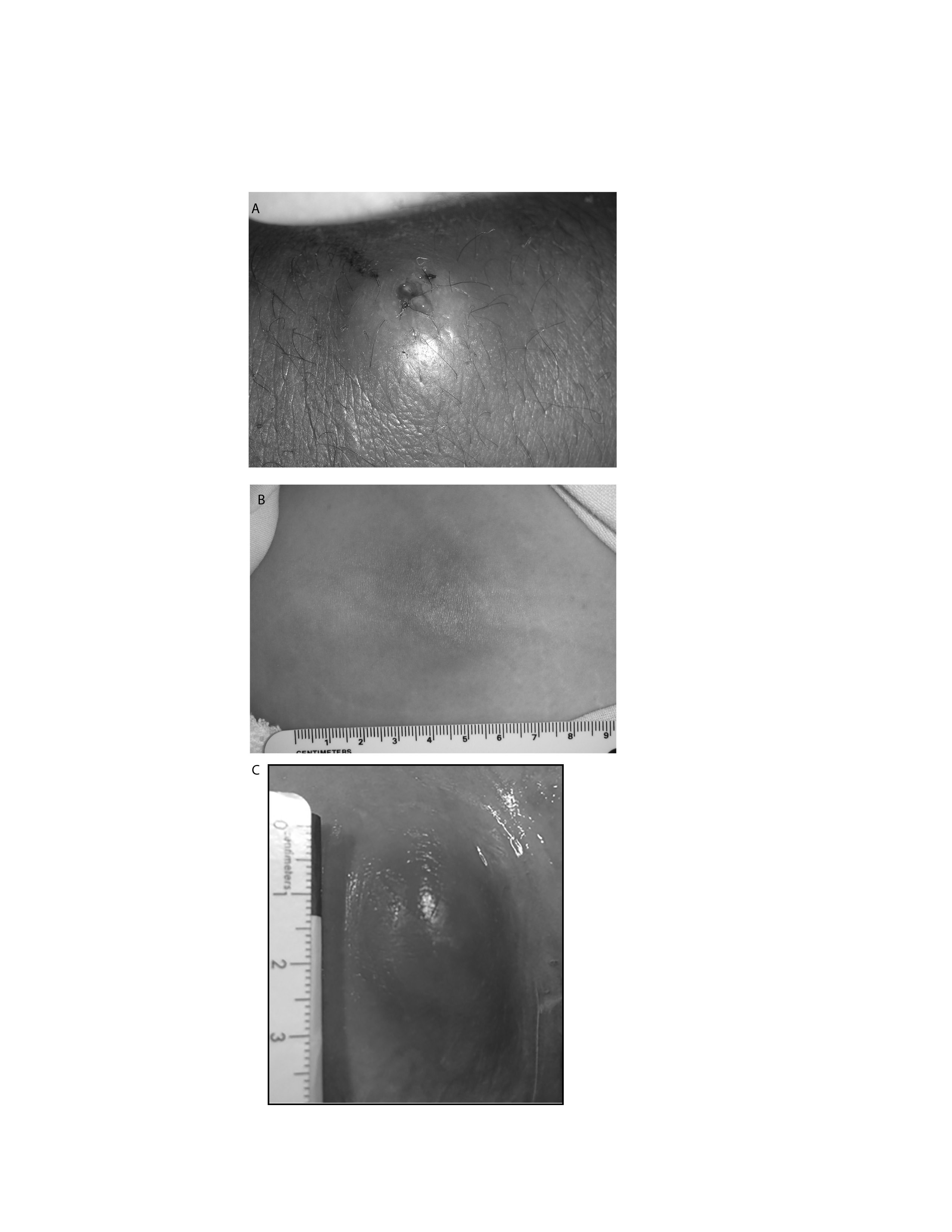 cutaneous abscess