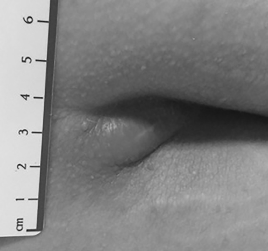 pilonidal abscess
