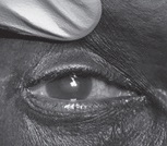 acute angle closure glaucoma