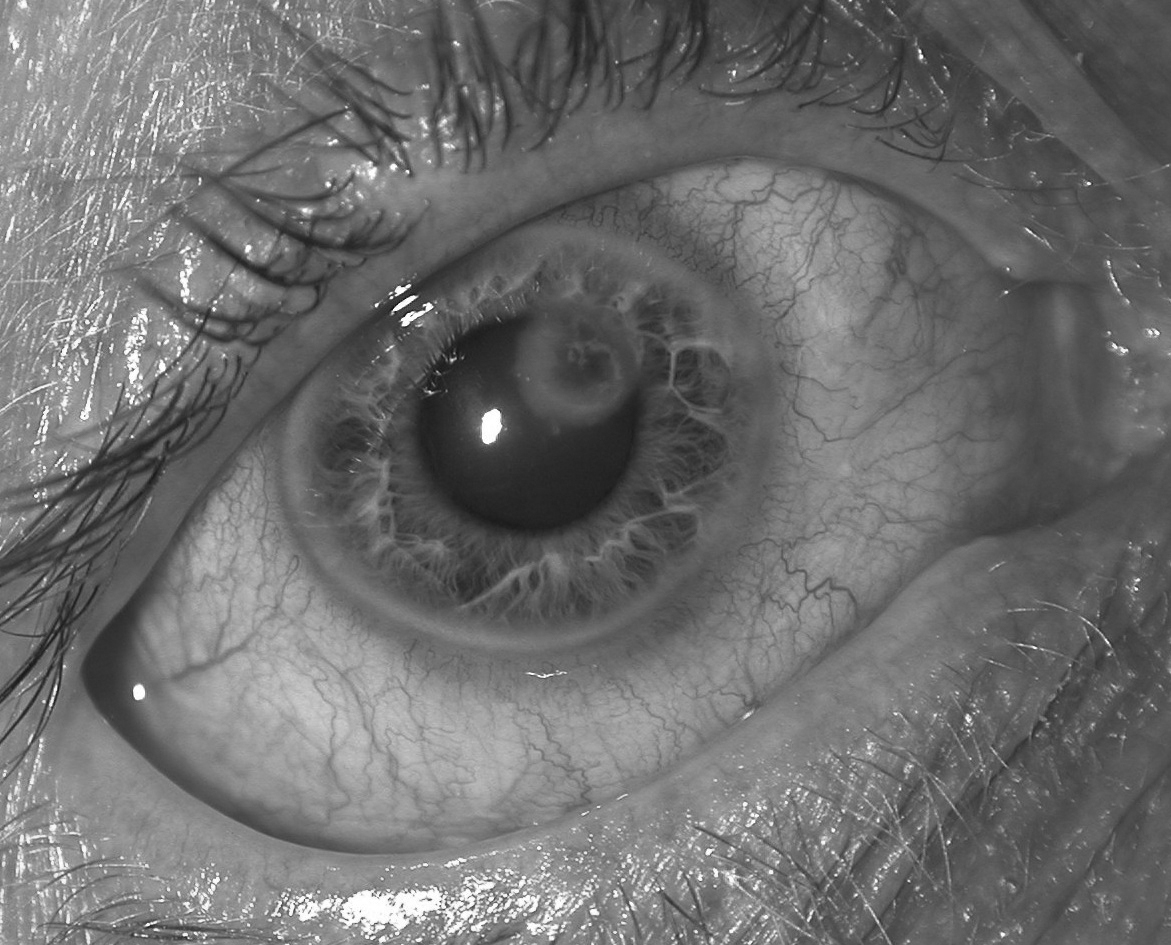 corneal ulcer