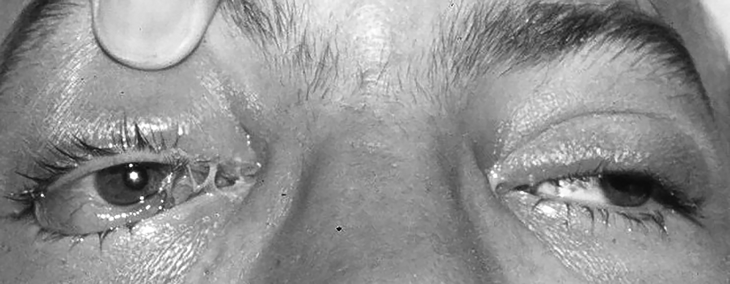 orbital cellulitis