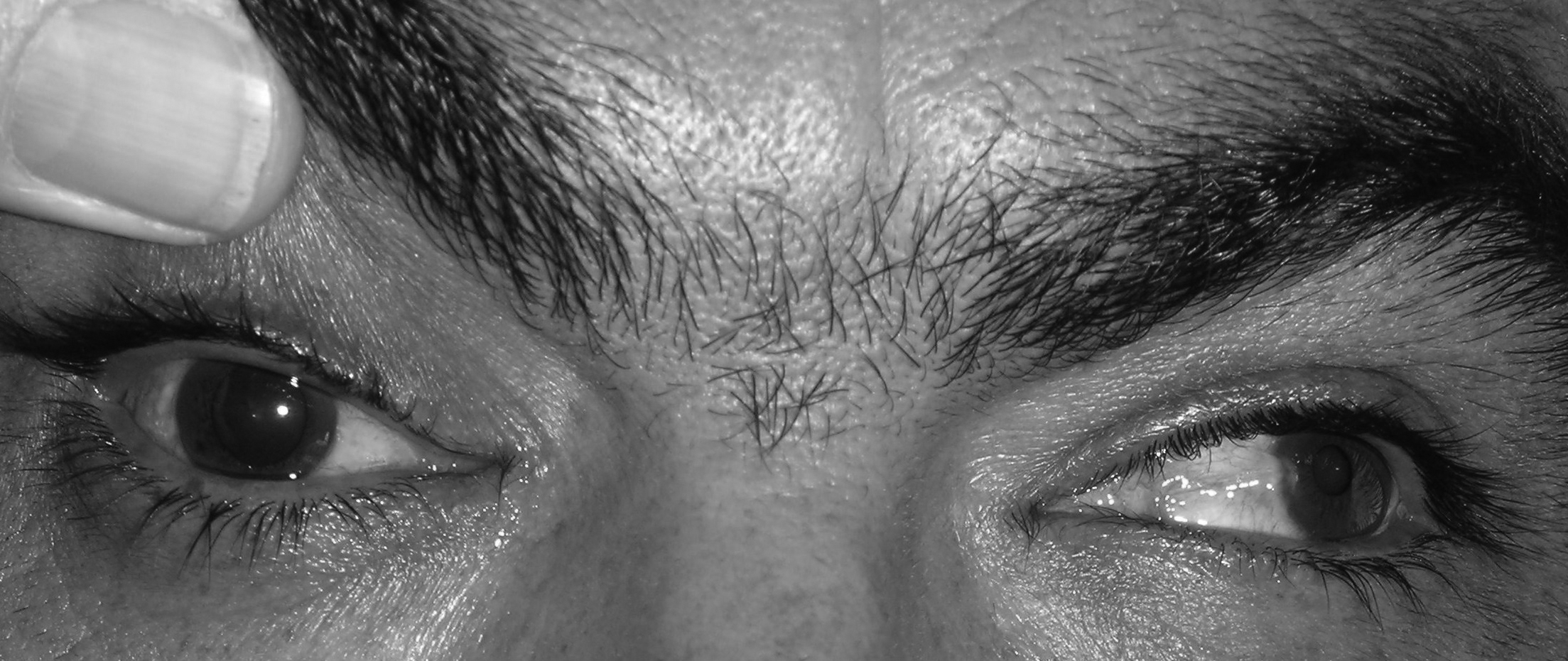third cranial nerve palsy