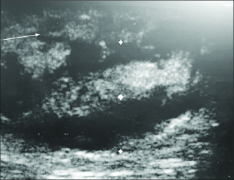 ultrasound cellulitis