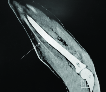 CT cellulitis