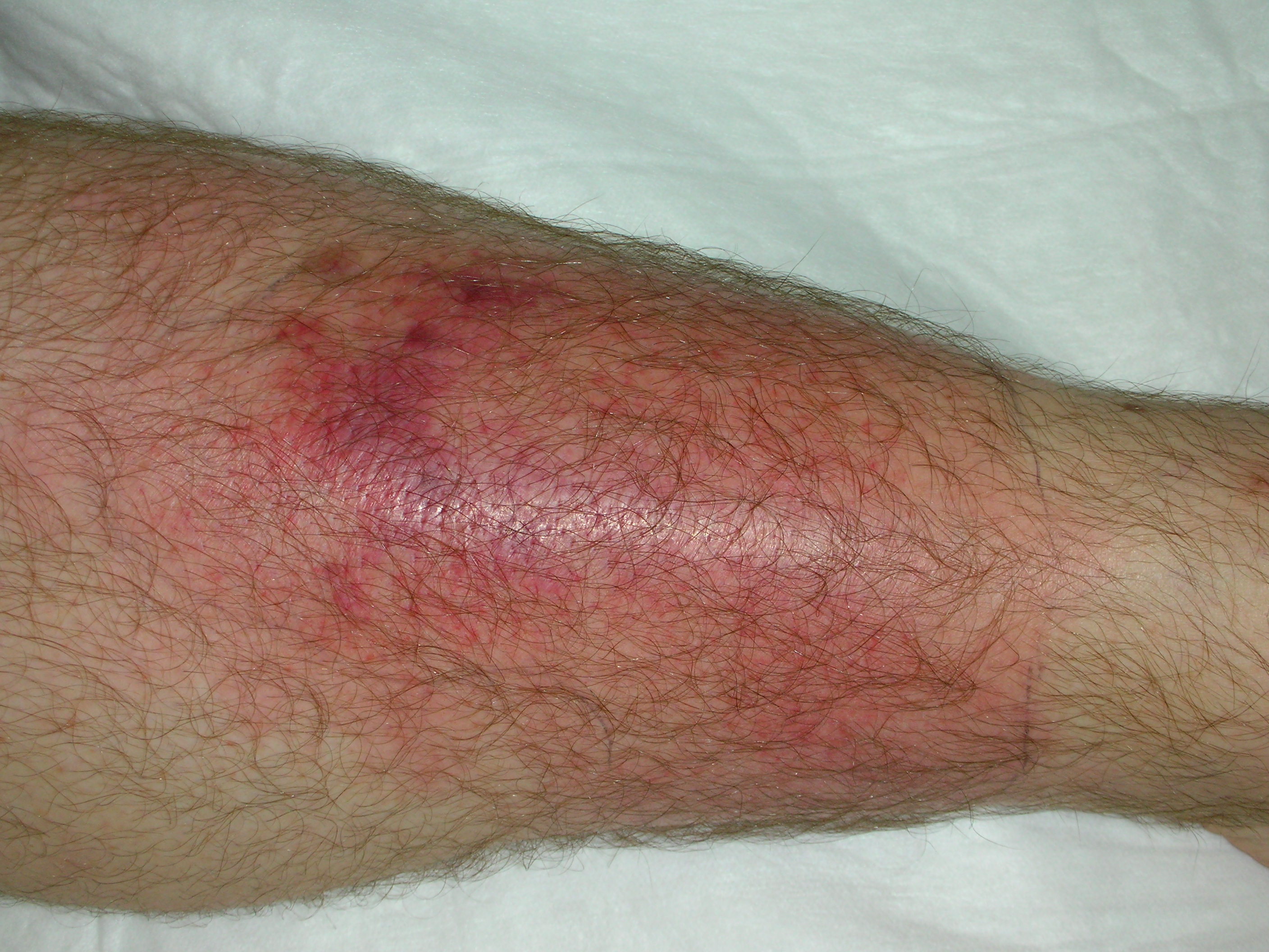 Shin cellulitis