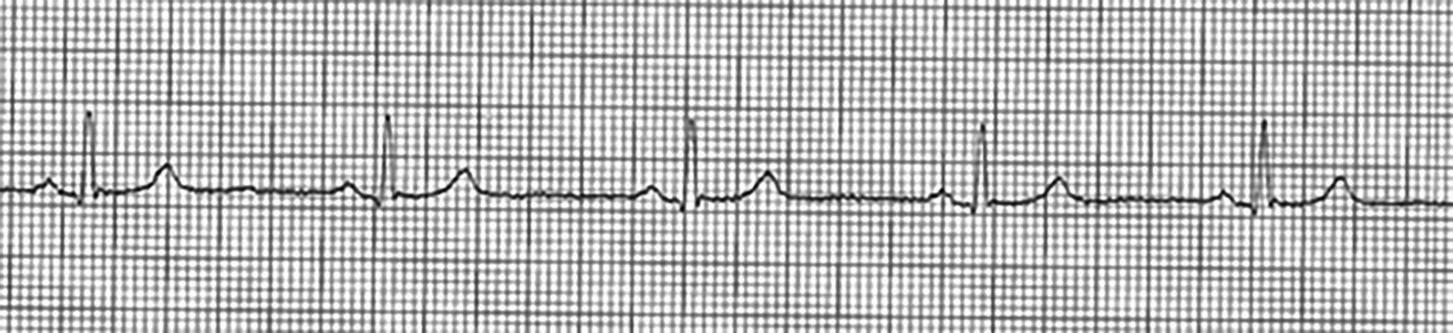 sinus bradycardia