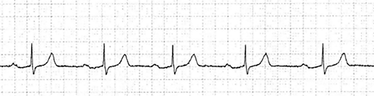 first-degree AV block