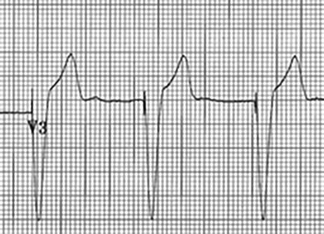 ventricular paced rhythm