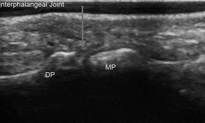 Distal Interphalangeal Joint Ultrasound