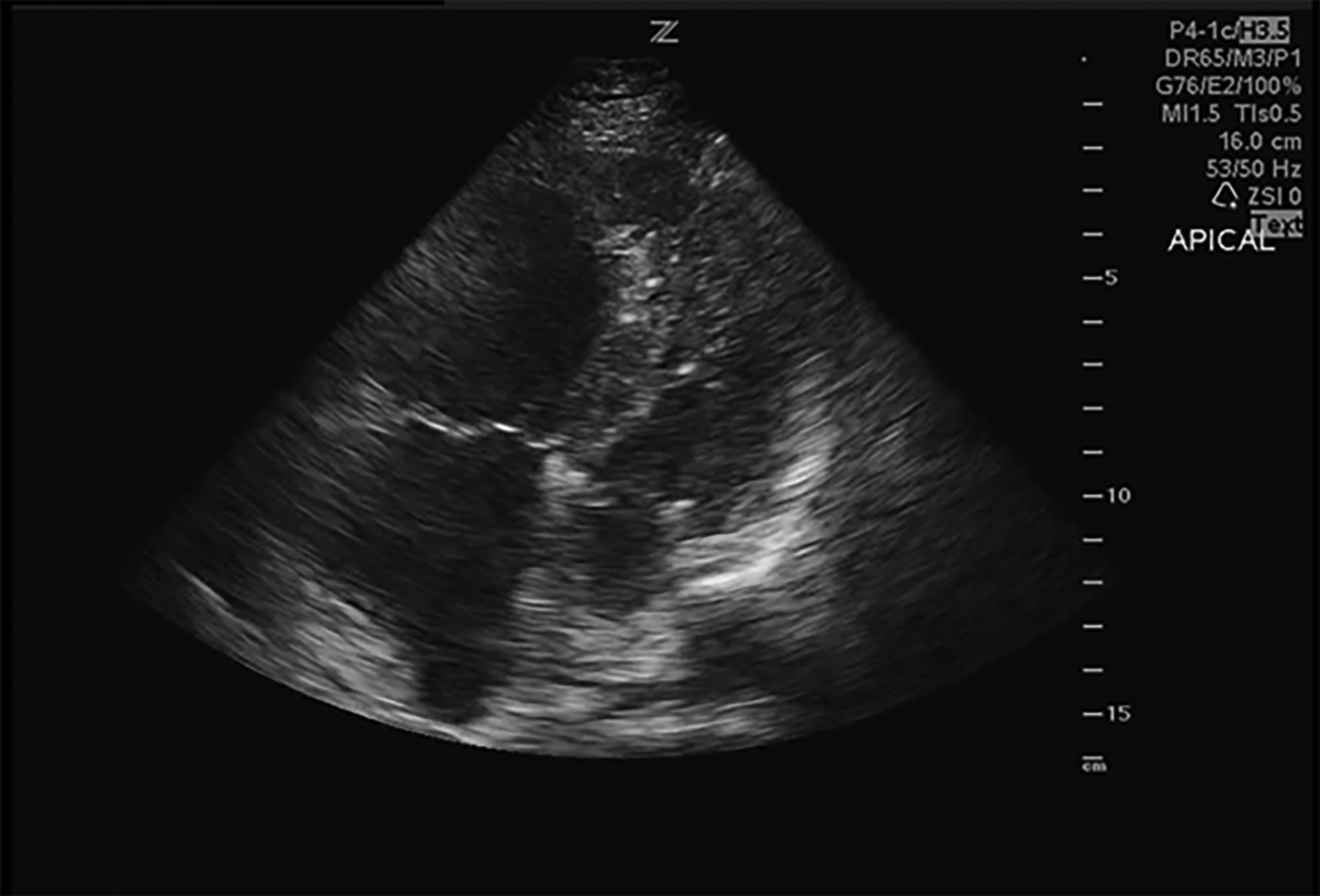 Apical four-chamber