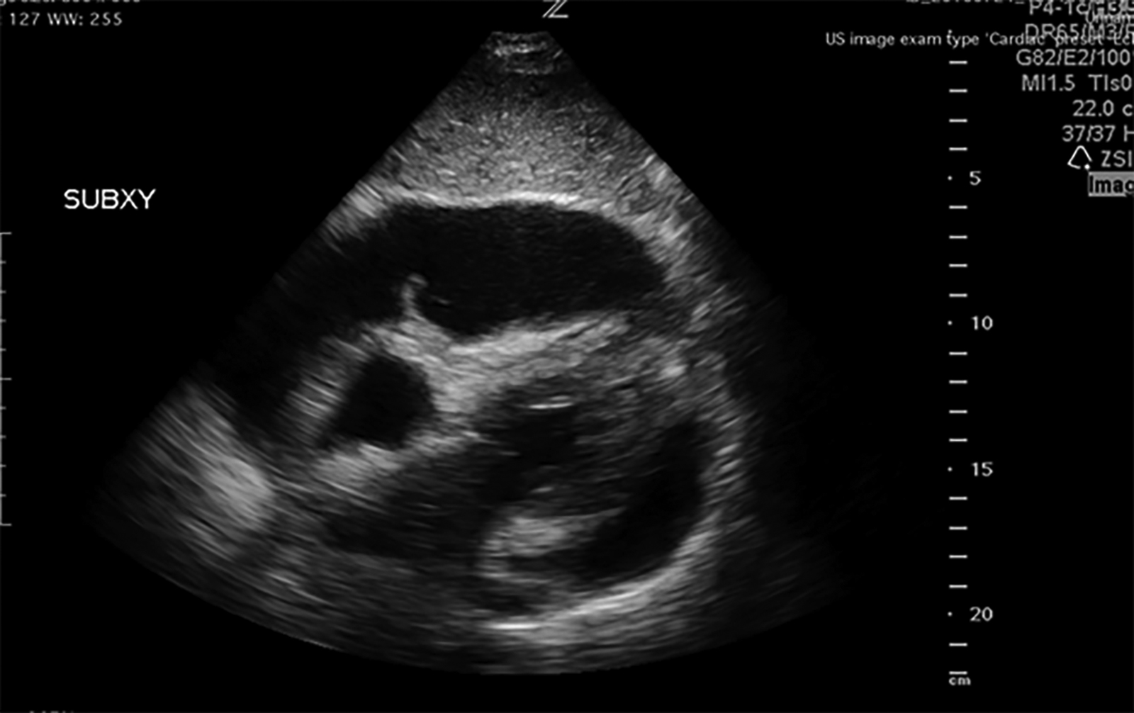 Subxiphoid view