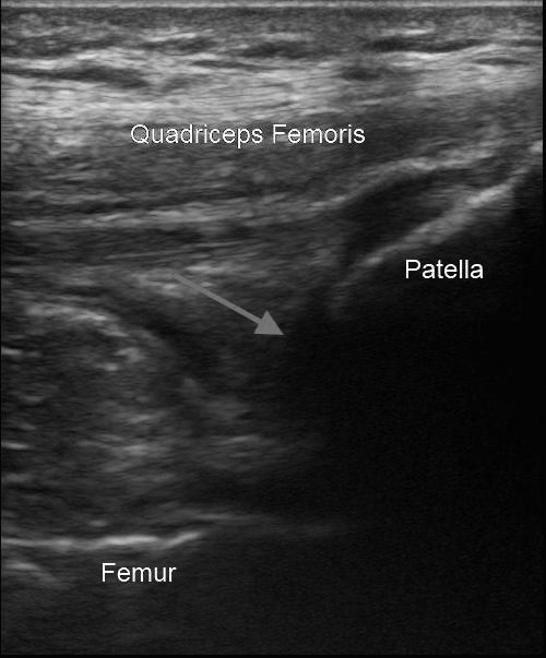 Knee ultrasound