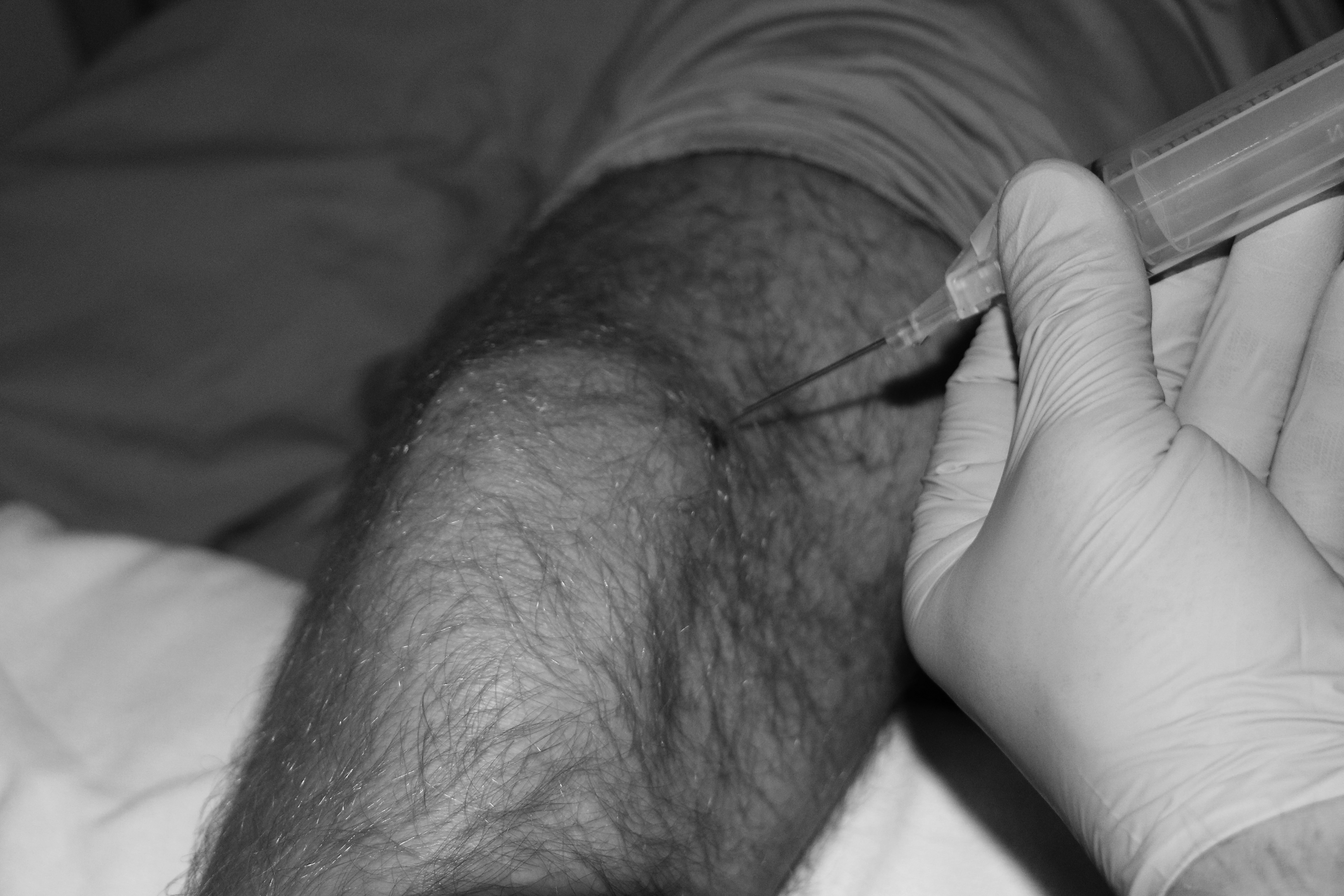 Knee suprapatellar