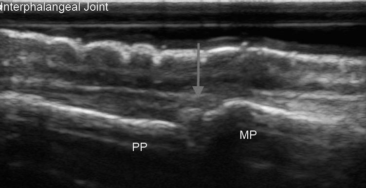 Proximal Interphalangeal Joint Ultrasound