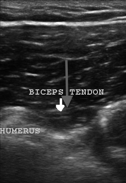 Shoulder arthrocentesis