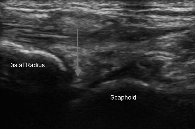 Wrist ultrasound