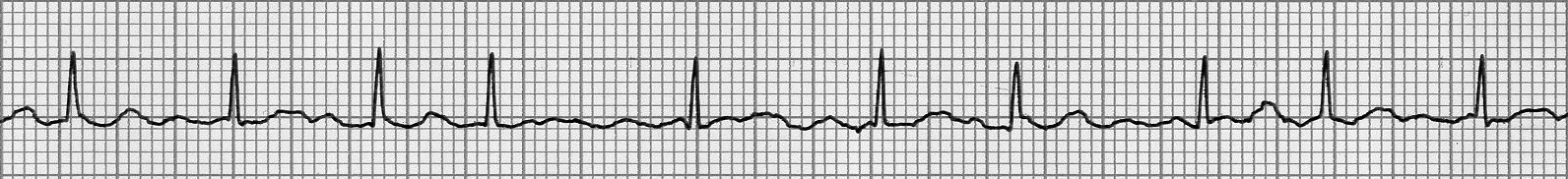atrial fibrillation