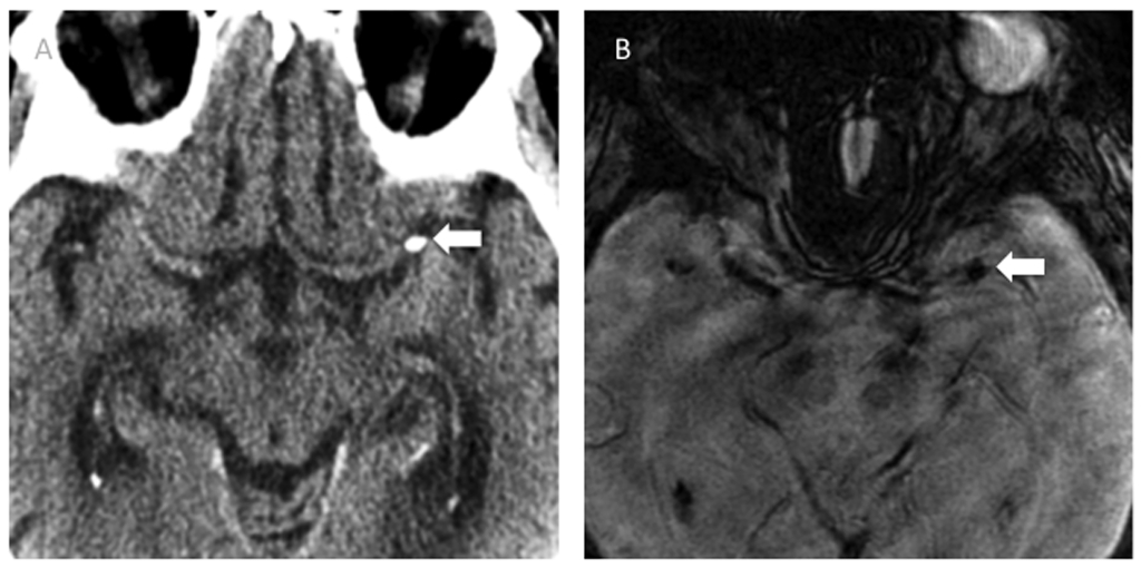 Calcified embolus in MCA