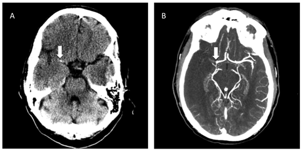 Hyperdense middle cerebral artery sign