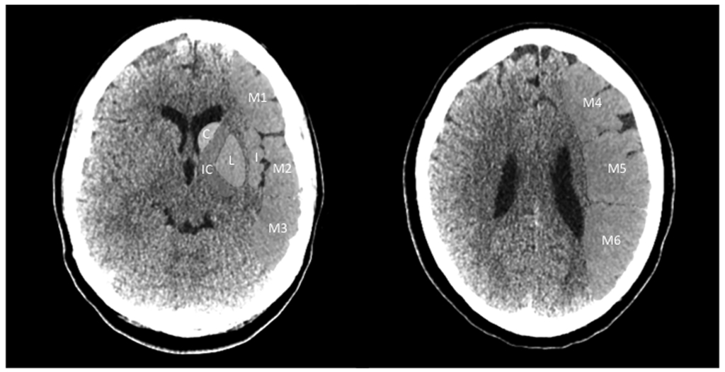 Alberta Stroke Program Early CT Score