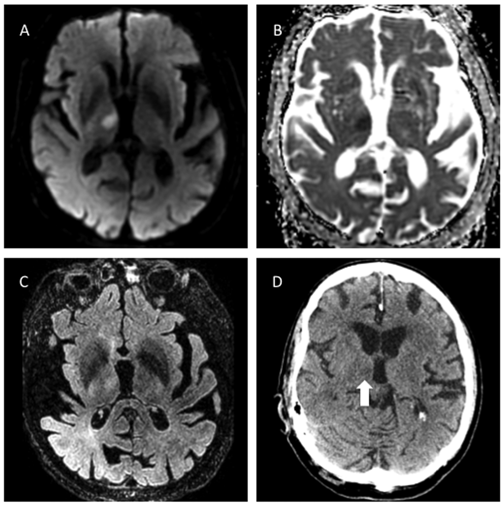 Acute thalamic infarction