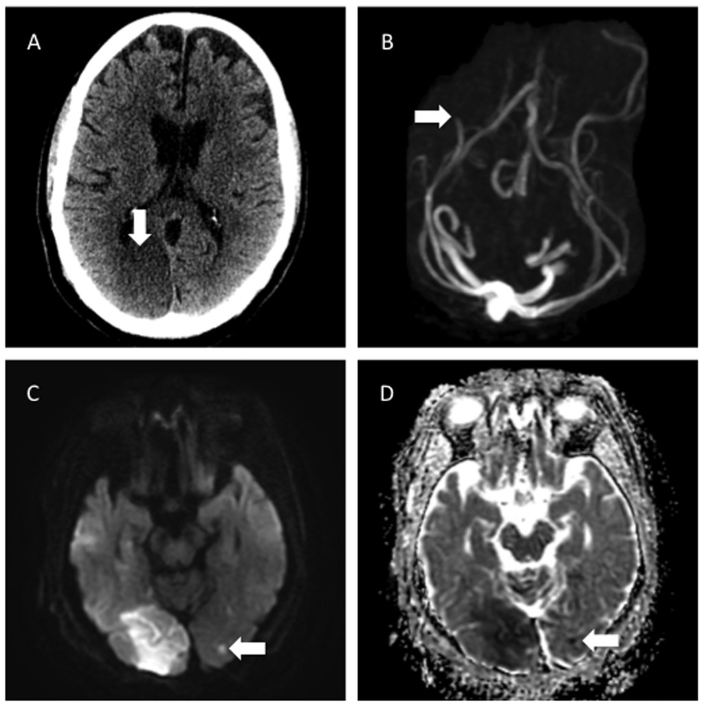 Acute posterior cerebral artery infarctions