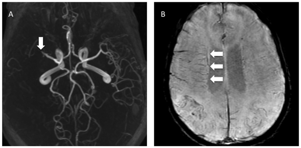 Middle cerebral artery occlusion