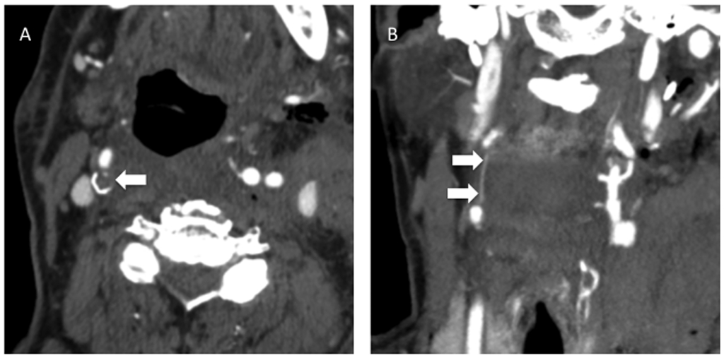 Severe internal carotid artery stenosis