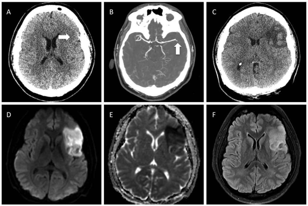 Hemorrhagic transformation of anterior MCA