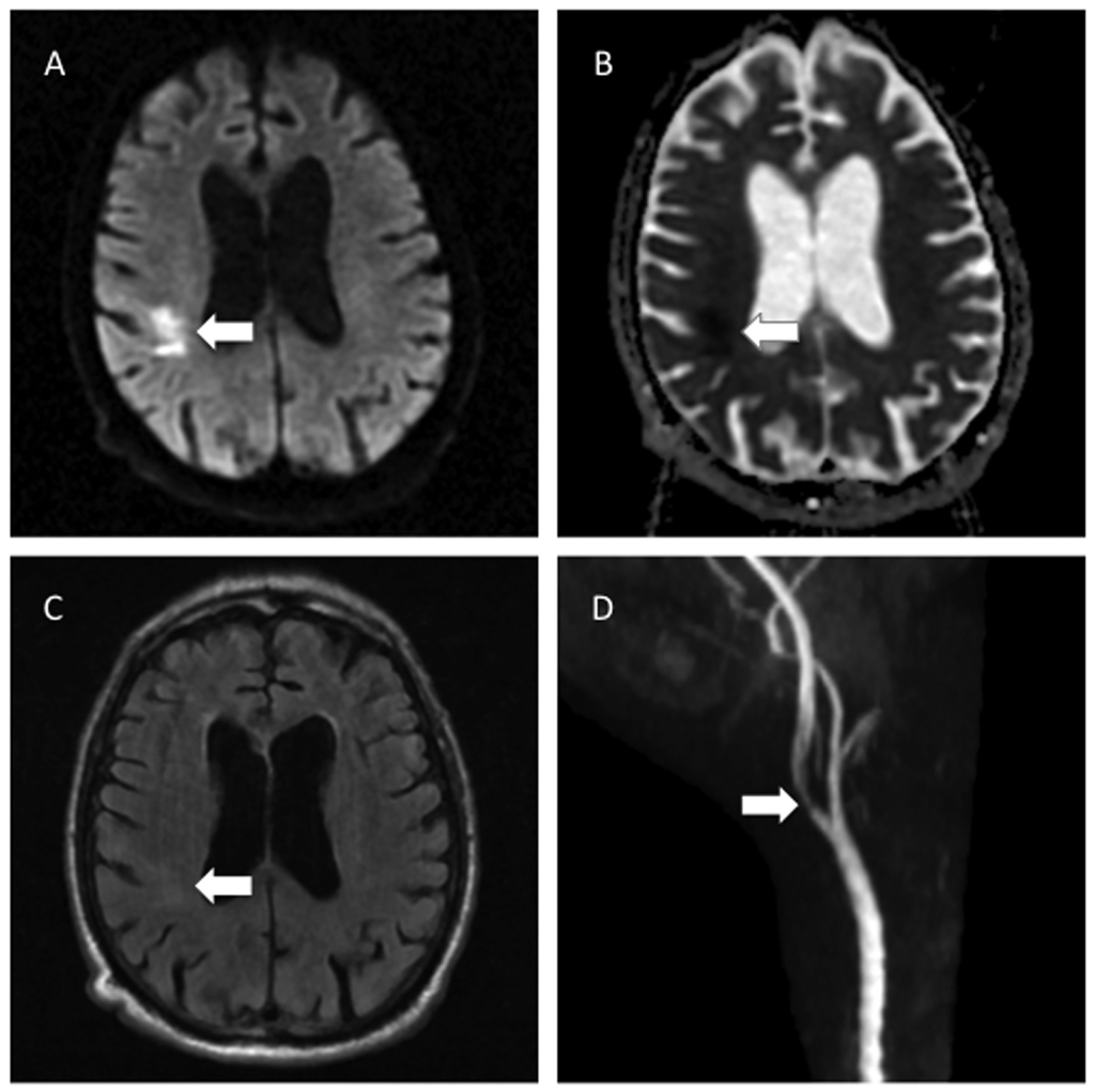Acute infarction with proximal internal artery stenosis
