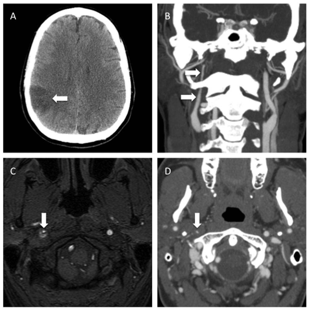 Cervical ICA Dissection